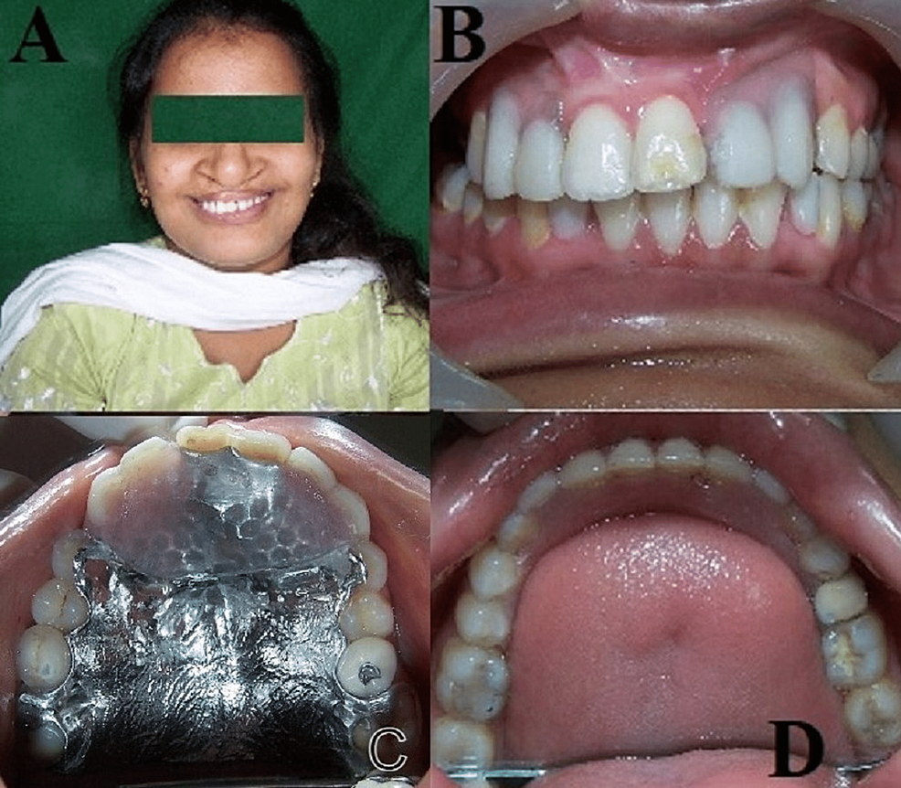 Prosthodontic Rehabilitation of a Residual Postsurgical Cleft Defect