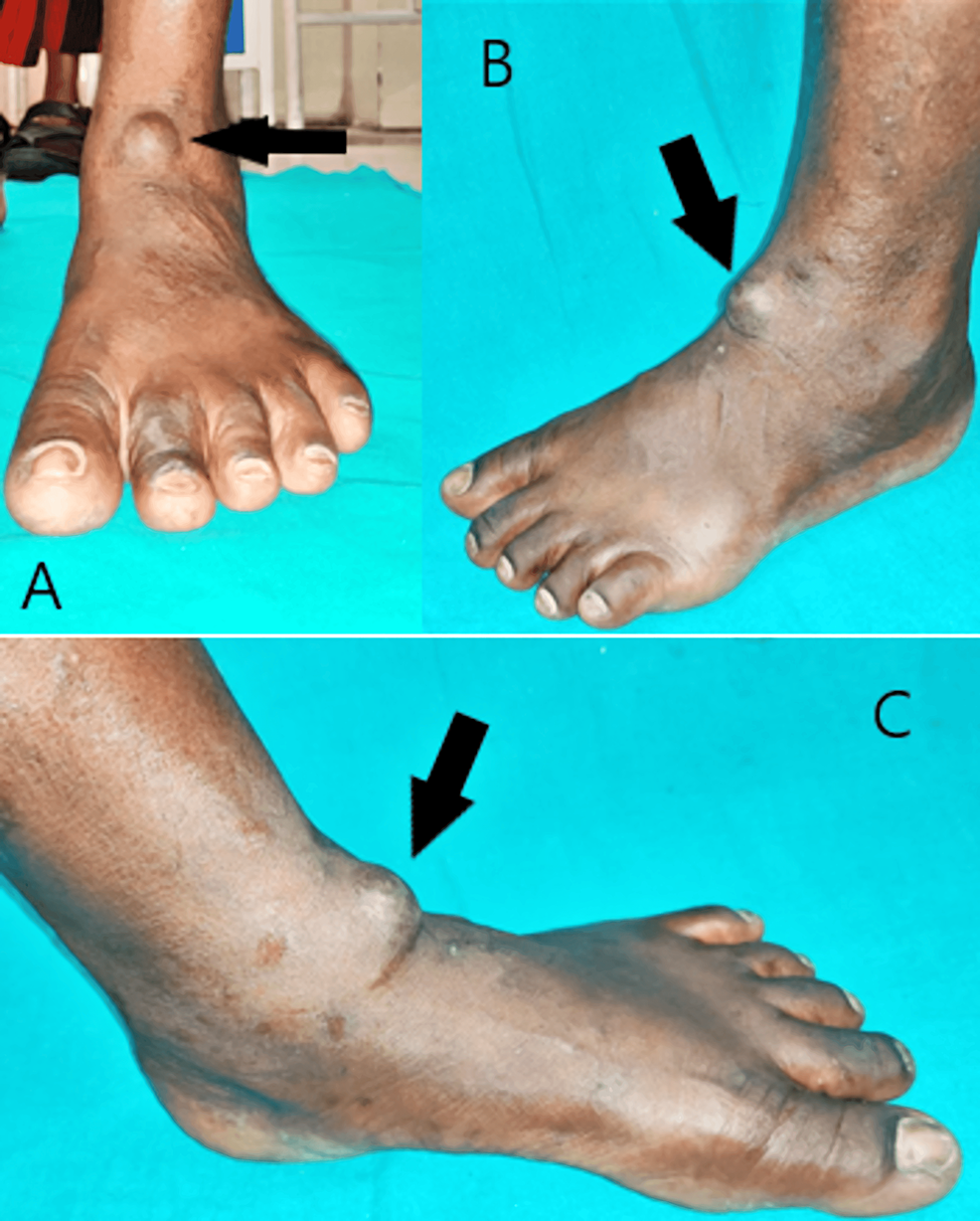 Cureus | Subcutaneous Angiofibroma of the Ankle: A Rare, Undescribed  Clinical Entity