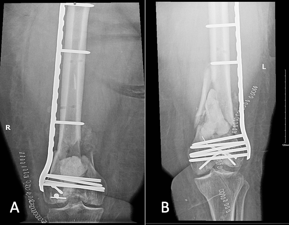 Outcome Of The Masquelet Technique For Complex Bilateral Distal Femoral ...