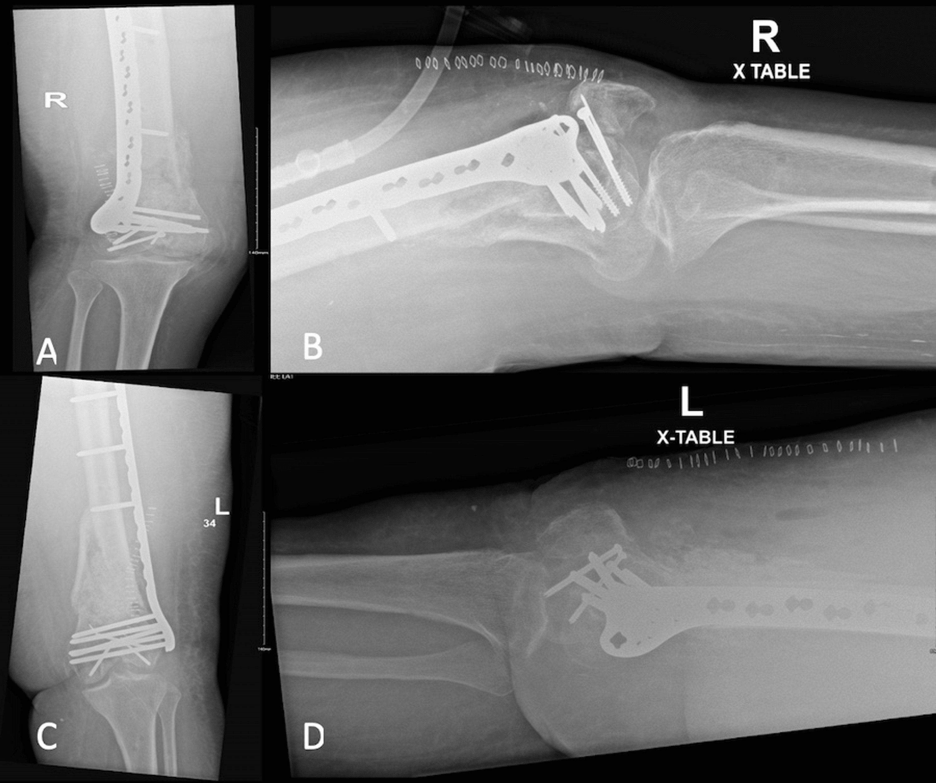 Outcome Of The Masquelet Technique For Complex Bilateral Distal Femoral ...