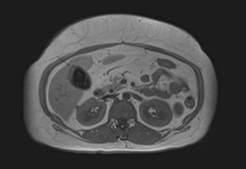Cureus | Adenosquamous Carcinoma of the Gallbladder: Case Report of a ...