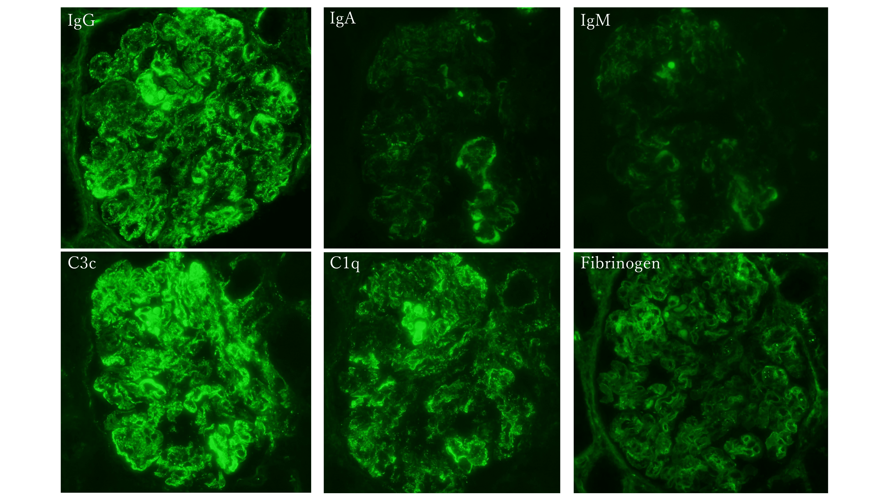 Cureus A Case of Mixed Connective Tissue Disease That Transformed