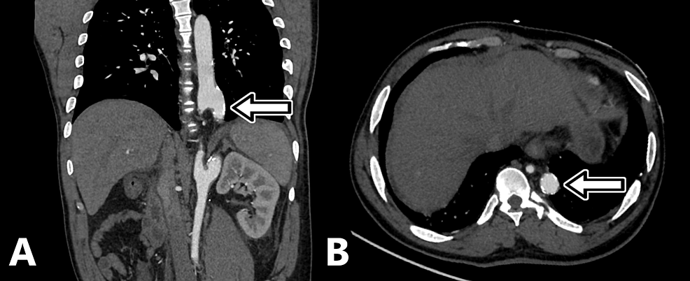 Overlapping descending aorta leading to early focal vascular disease