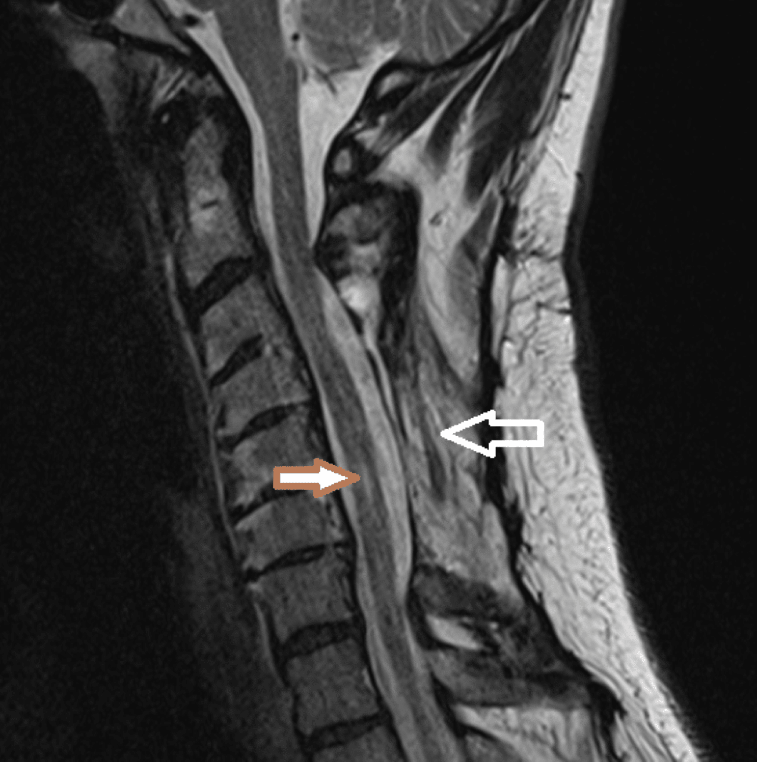 Guillain Barre Syndrome Hesi Case Study - jug5uek