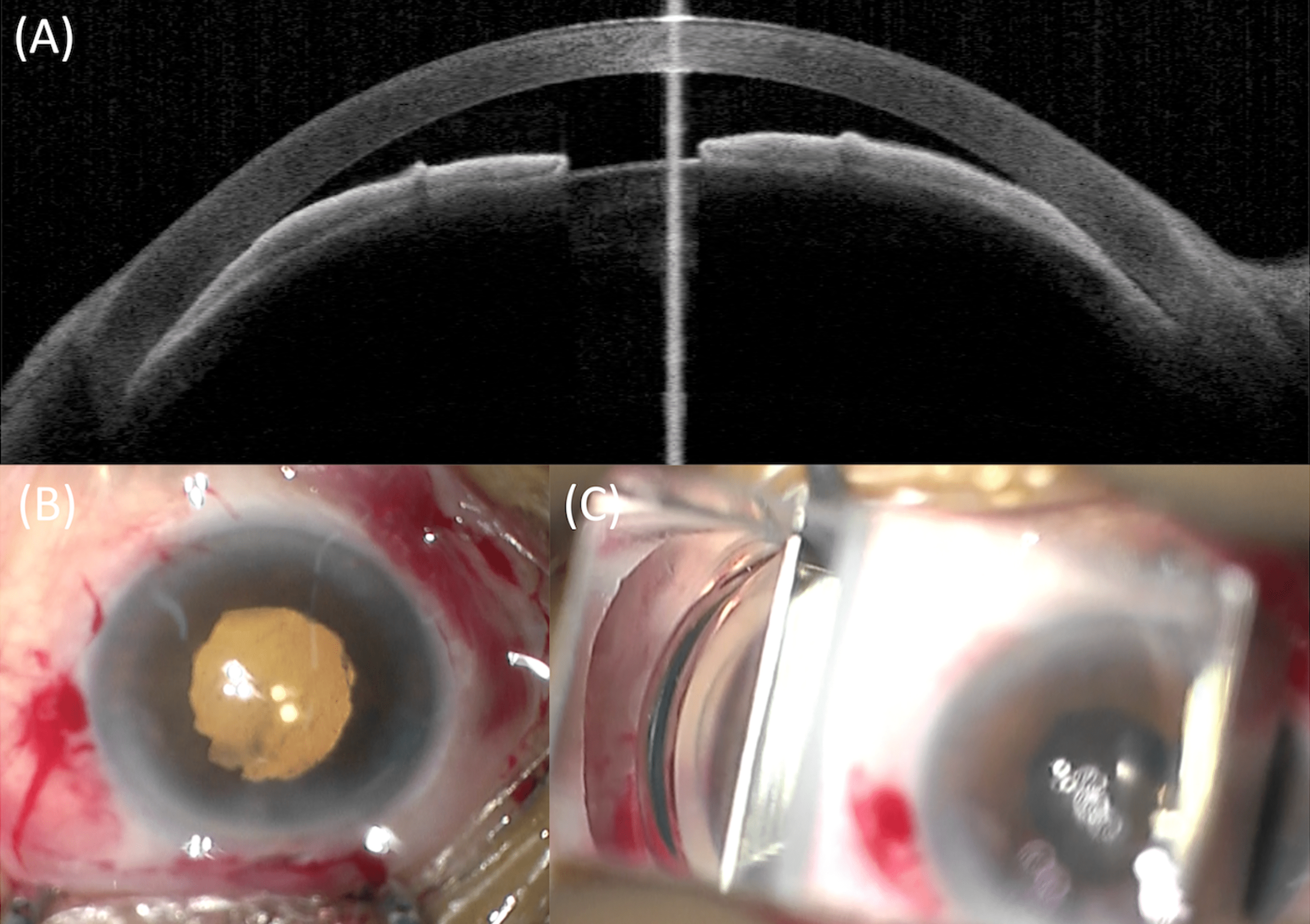 Malignant After Immediate Primary Phacoemulsification for Acute Primary Angle Closure