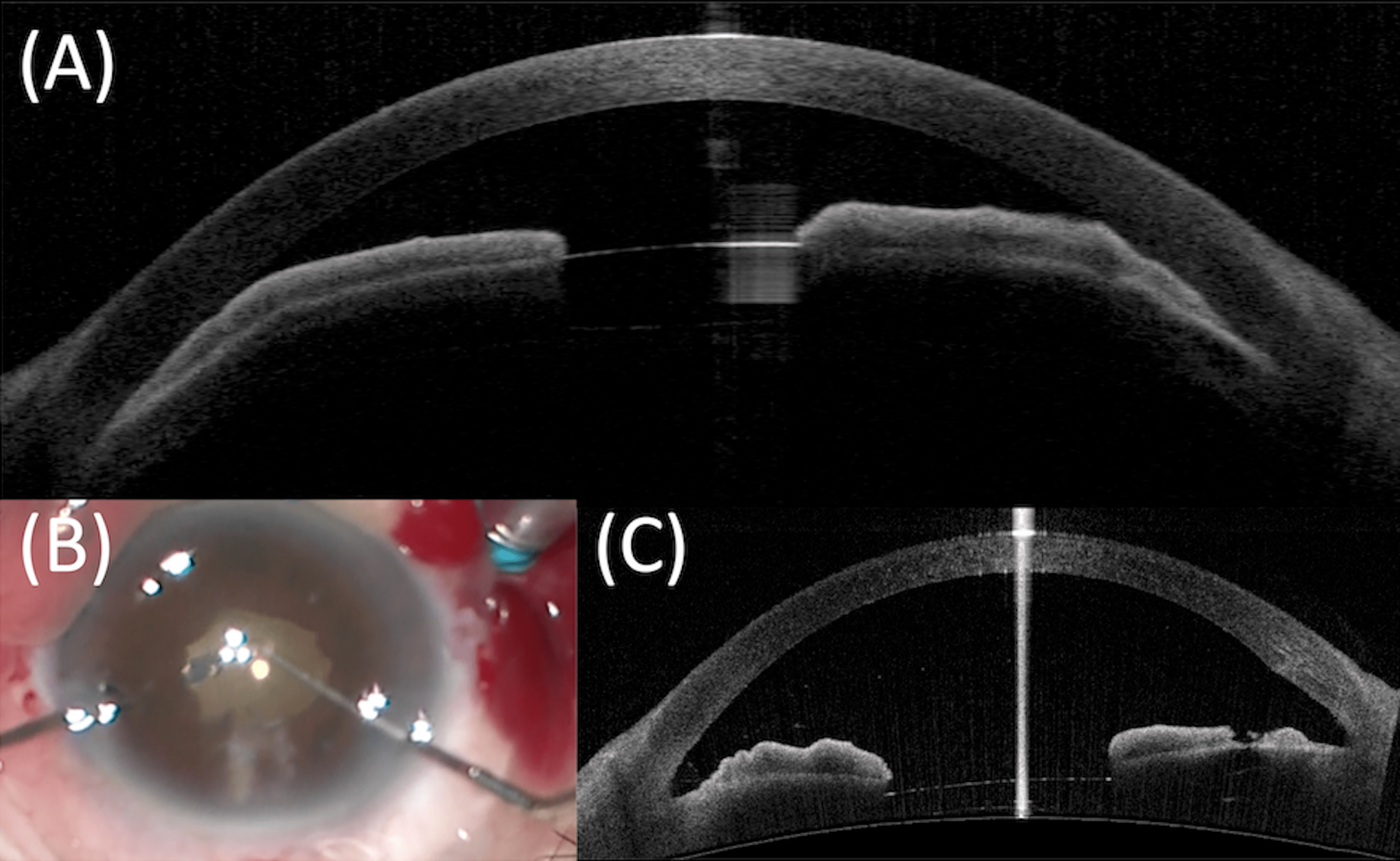 Cureus Malignant After Immediate Primary Phacoemulsification