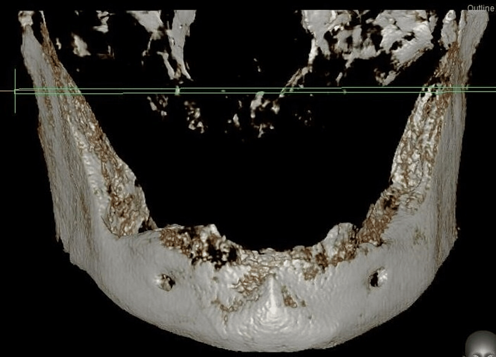 Biomechanical comparison of different prosthetic materials and posterior  implant angles in all-on-4 treatment concept by three-dimensional finite  element analysis