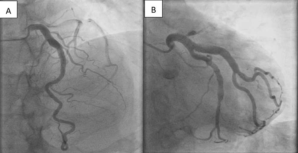 Cureus Ectatic Coronary Arteries Diversity at Its Finest