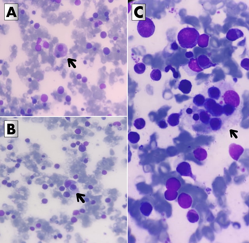 cureus-hemophagocytic-lymphohistiocytosis-with-obstructive-jaundice