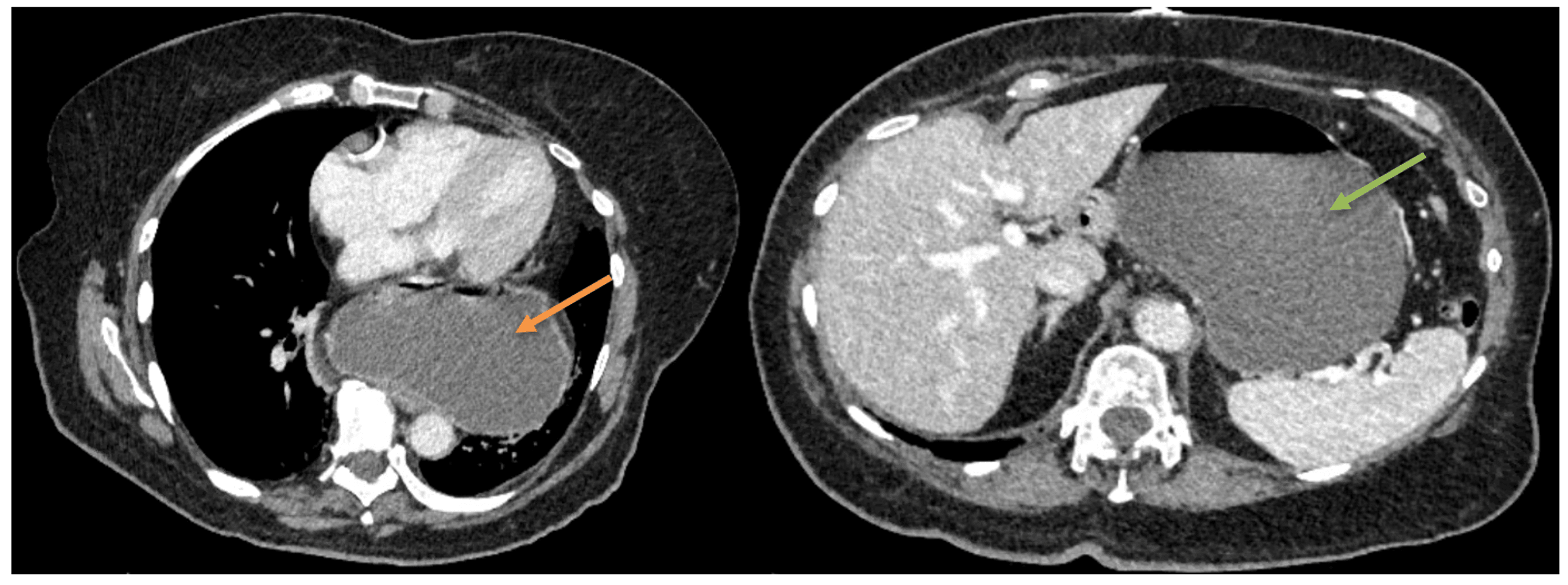 Gastric Outlet Obstruction Caused by Acute Gastric Volvulus A Rare
