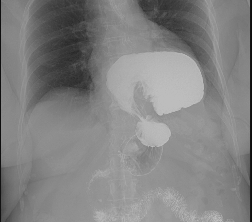 Gastric Outlet Obstruction Caused by Acute Gastric Volvulus A Rare