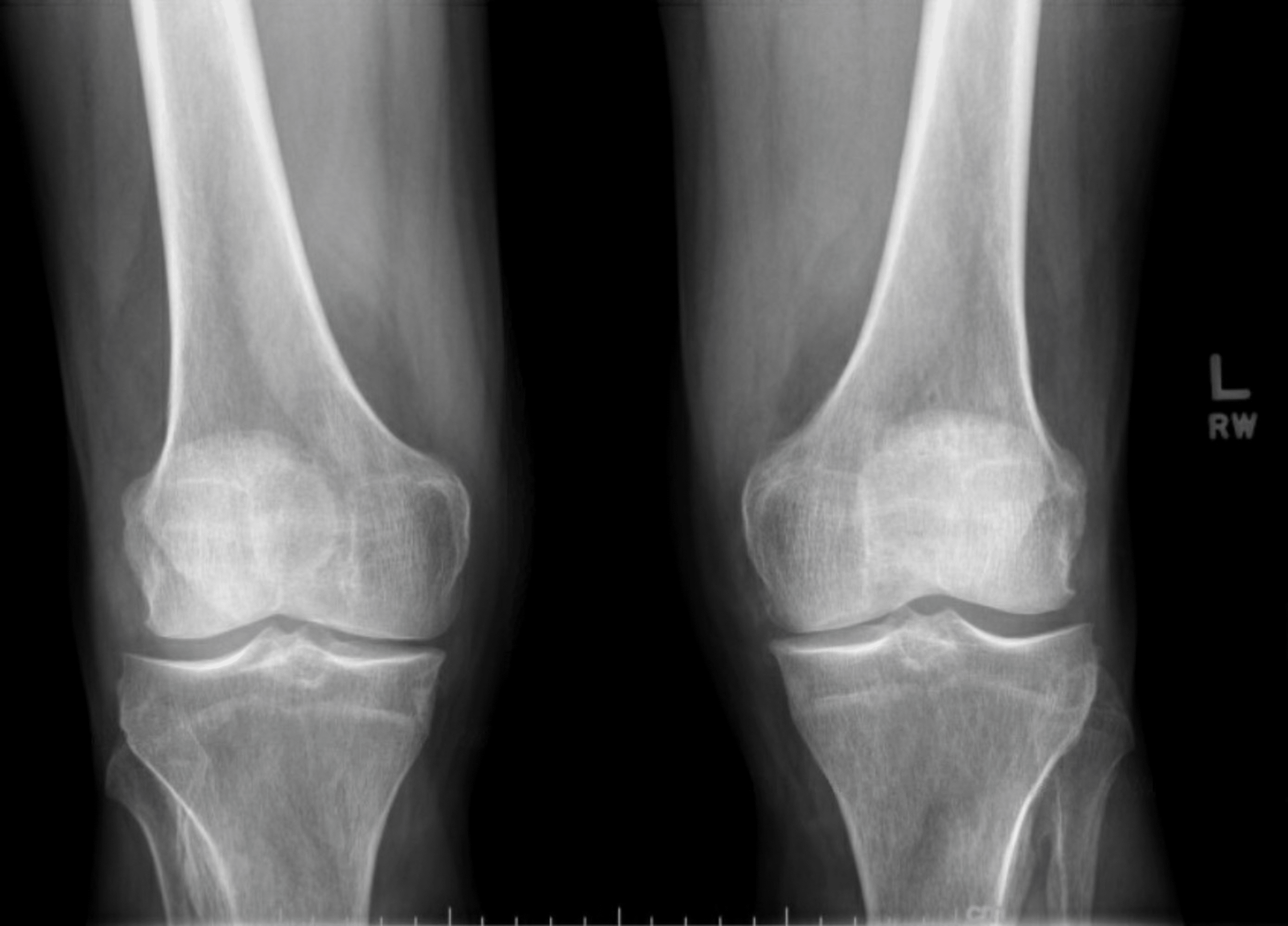 Cureus | Dual-Energy Computed Tomography (DECT) Resolves the Diagnostic ...