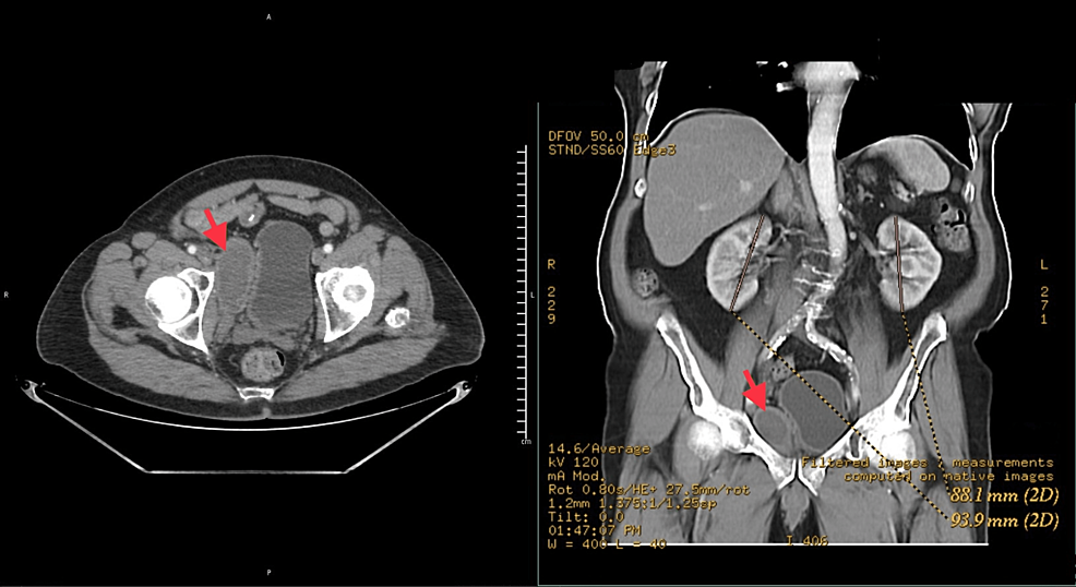 Pelvic Hematoma After UroLift A Case Report and Literature Review Cureus