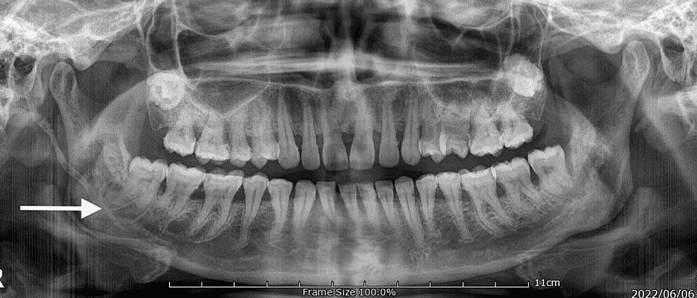 Panoramic and Towne view radiographs of right mandibu- lar angle