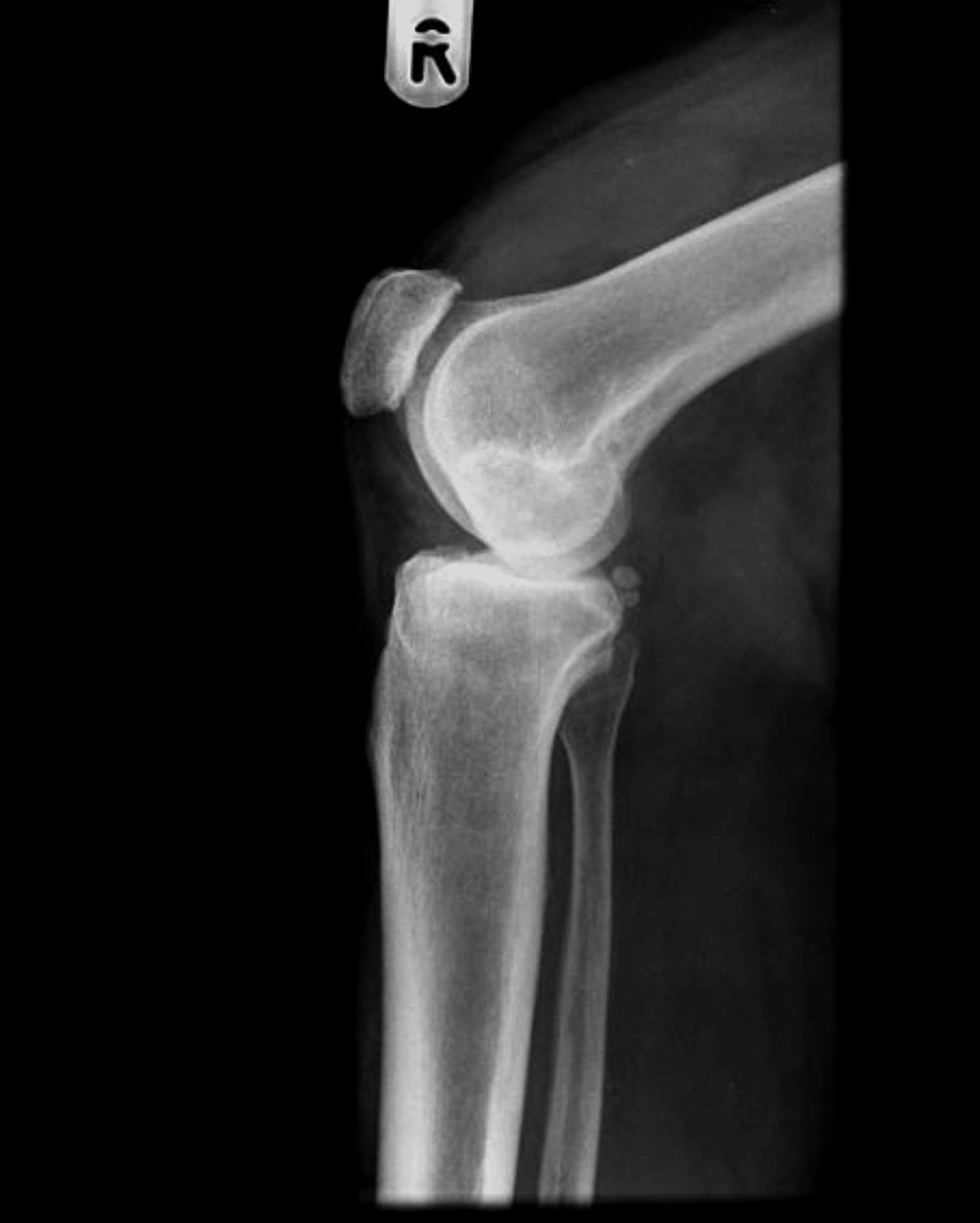 Cementless Mobile-bearing Total Knee Arthroplasty: 10 Years Follow-up 