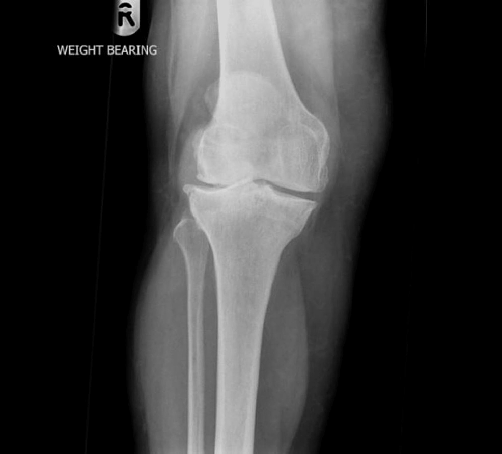 Cementless Mobile Bearing Total Knee Arthroplasty Years Follow Up