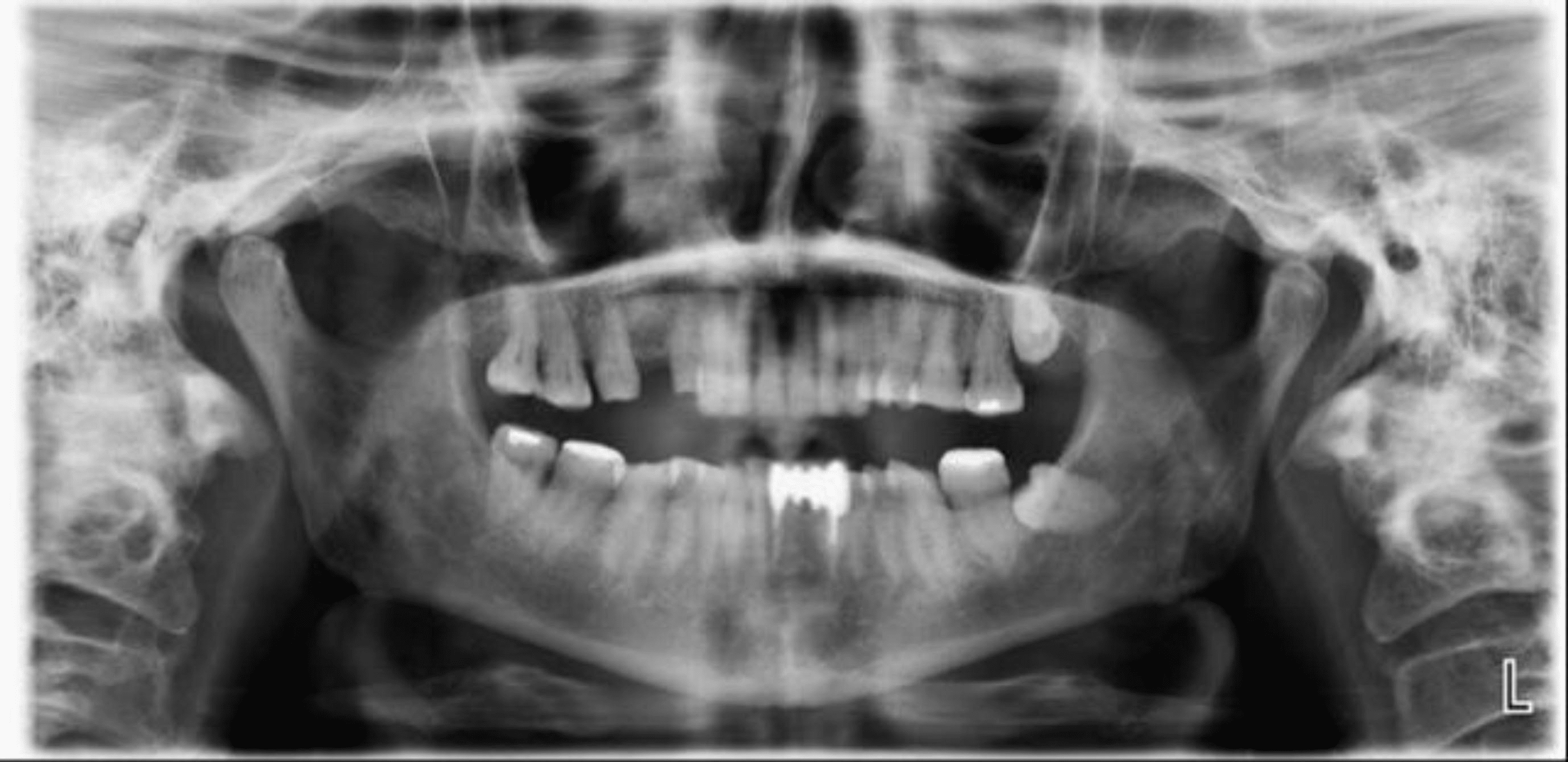 Restorative Rehabilitation Of A Patient With Tooth Wear: A One-Year ...