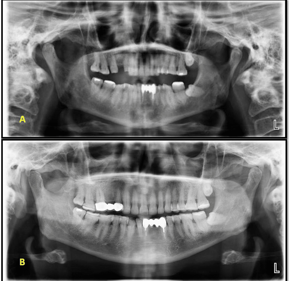 Restorative Rehabilitation Of A Patient With Tooth Wear A One Year Clinical Follow Up Report