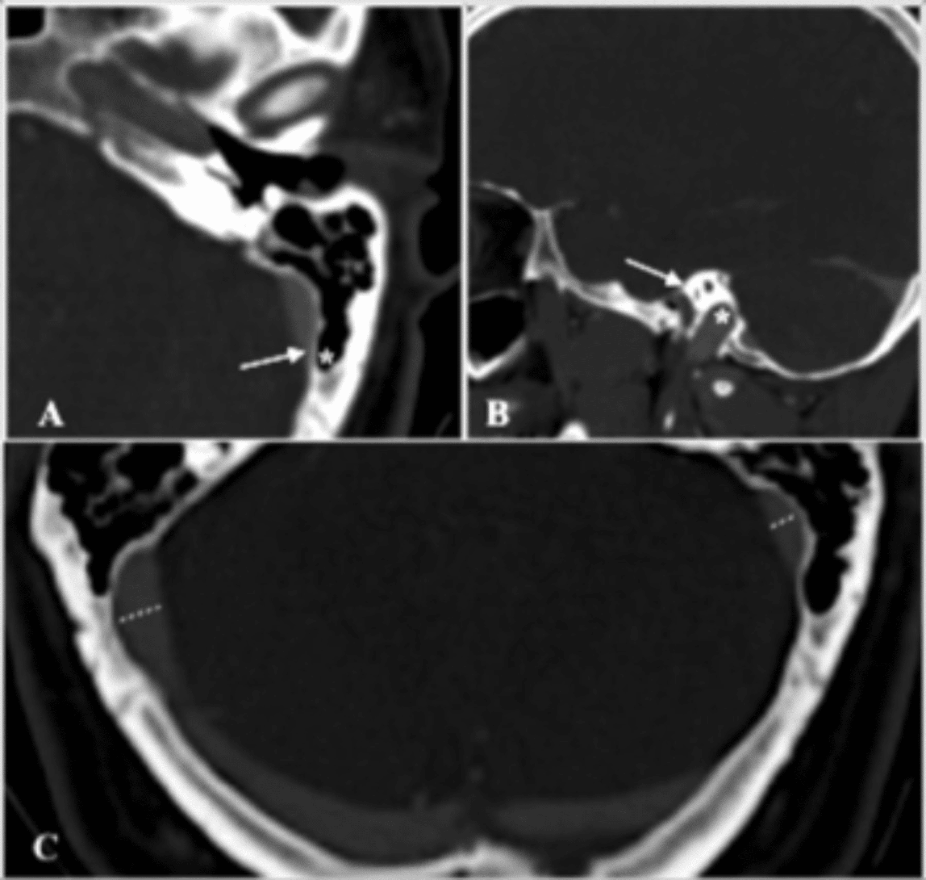 Cureus | Rasmussen's Aneurysm: A Rare Case