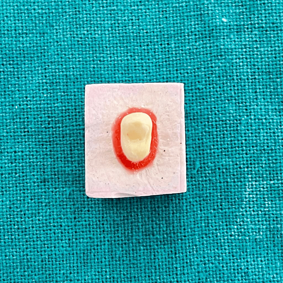 Comparative Effect of No Finish Line, Heavy Chamfer, and Shoulder
