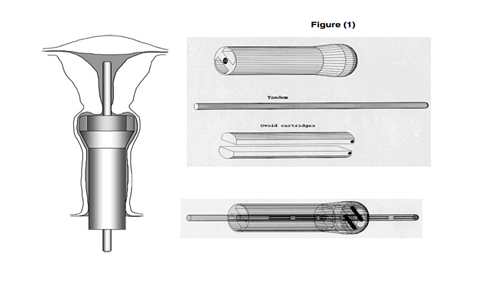 Cureus A Novel Applicator for Intracavitary LowDoseRate