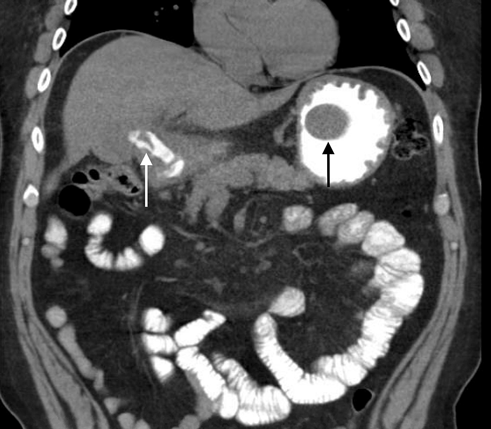 cureus-bouveret-syndrome-a-rare-and-often-fatal-form-of-gallstone-ileus