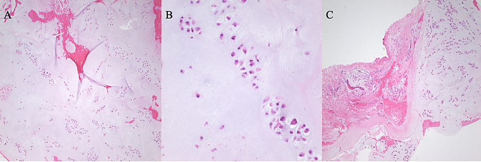 Hematoxylin-and-eosin-stain-in-low-magnification-shows-lobulated-areas-of-the-bland,-cartilaginous-neoplasm-(A);-high-magnification-shows-minimal-cytologic-atypia-and-two-binucleated-chondrocytes-(B);-low-magnification-shows-smooth-interface-between-periosteum-and-cartilaginous-tissue-(C).-
