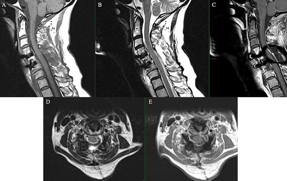 Magnetic-resonance-imaging-showing-a-gross-total-resection-of-tumor-on-sagittal-T1-weighted-image-(A),-hyperintense-on-sagittal-T2-weighted-image-(B),-sagittal-T1-weighted-image-with-gadolinium-in-the-sagittal-plane-(C).-On-the-axial-plane,-there-is-gross-total-resection-of-tumor-on-T2-weighted-image-(D)-and-T1-weighted-image-with-gadolinium-(E).