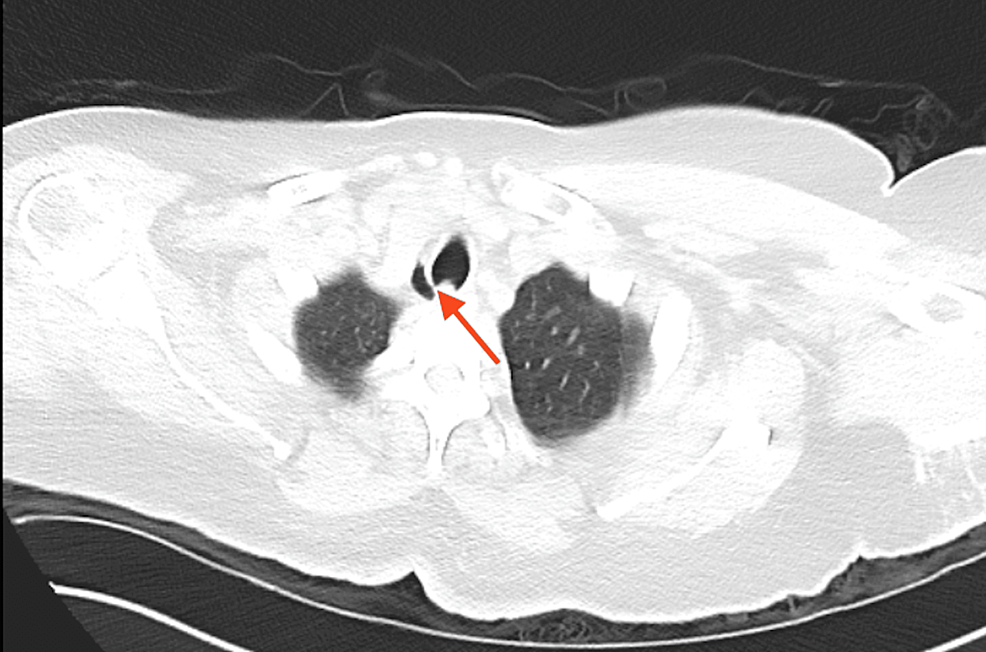 Tracheal Diverticulum Mimicking Pneumomediastinum A Case Report