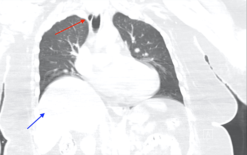 Cureus Tracheal Diverticulum Mimicking Pneumomediastinum A Case