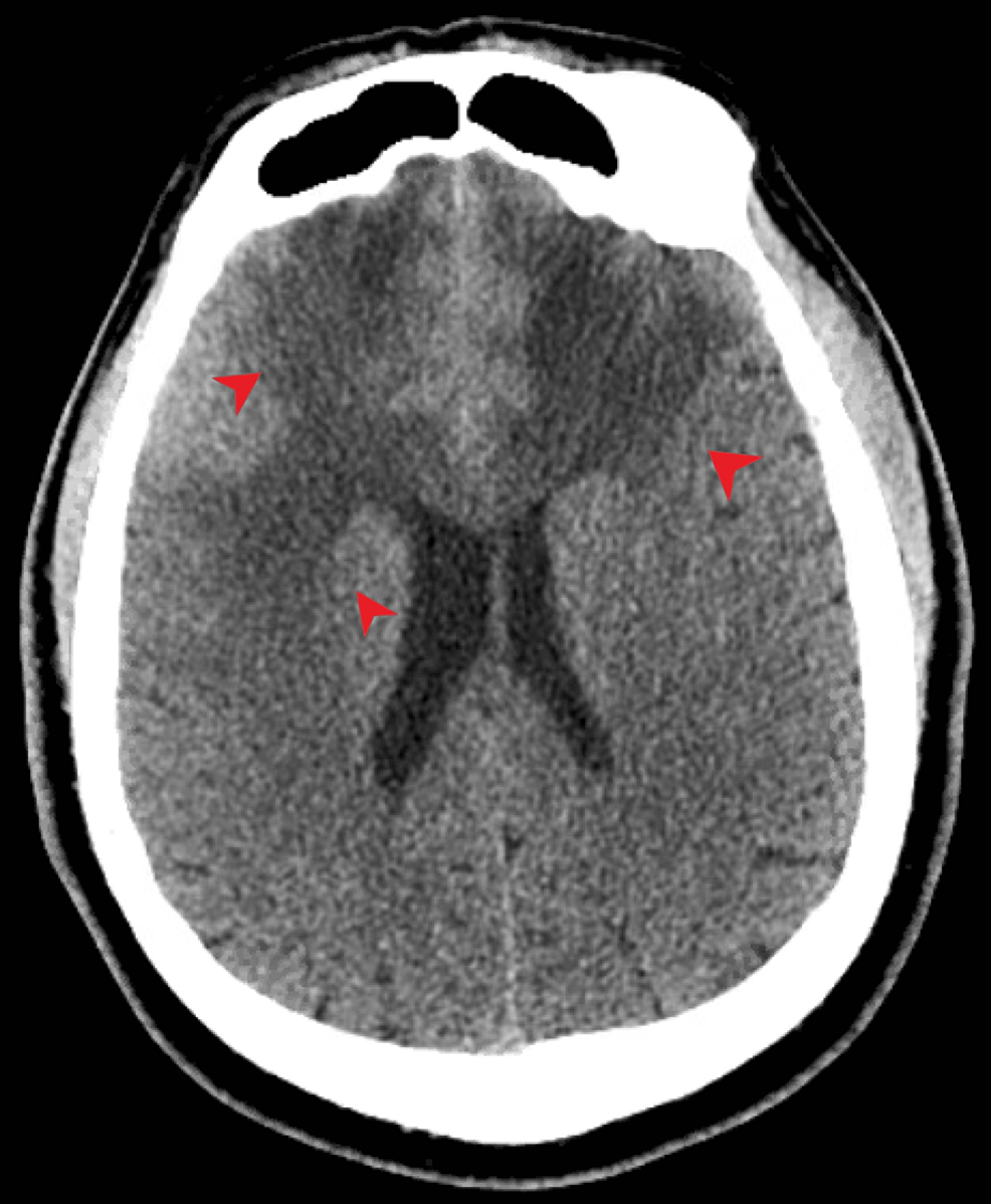 A Perplexing Case Of Bladder Mass Biopsy Proven Neurosarcoidosis Cureus