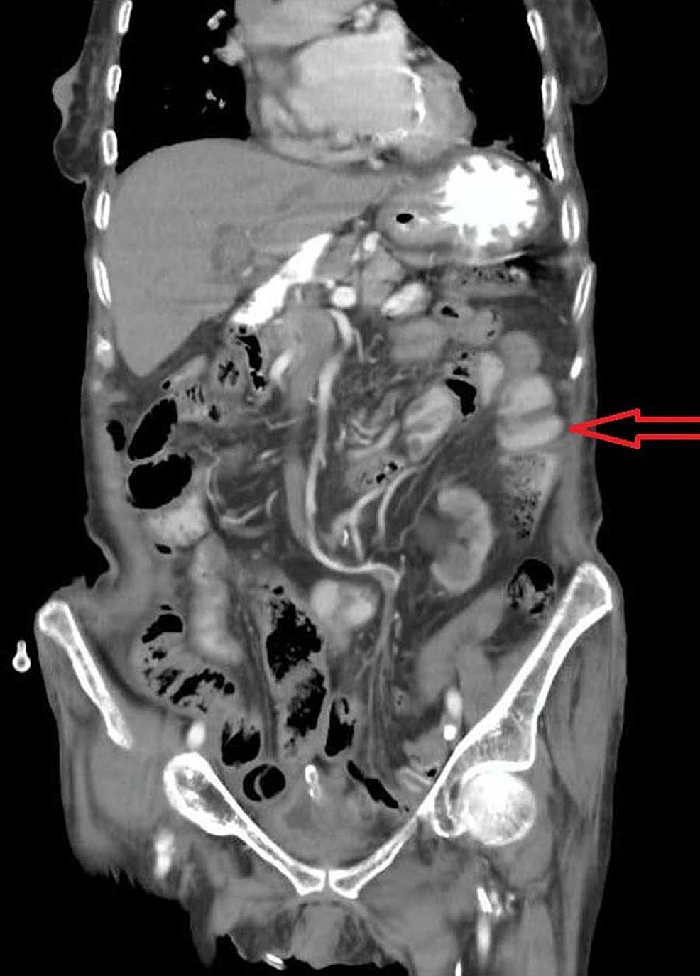 Rare Case of Peritonitis due to Ileal Perforation Secondary to Richter ...