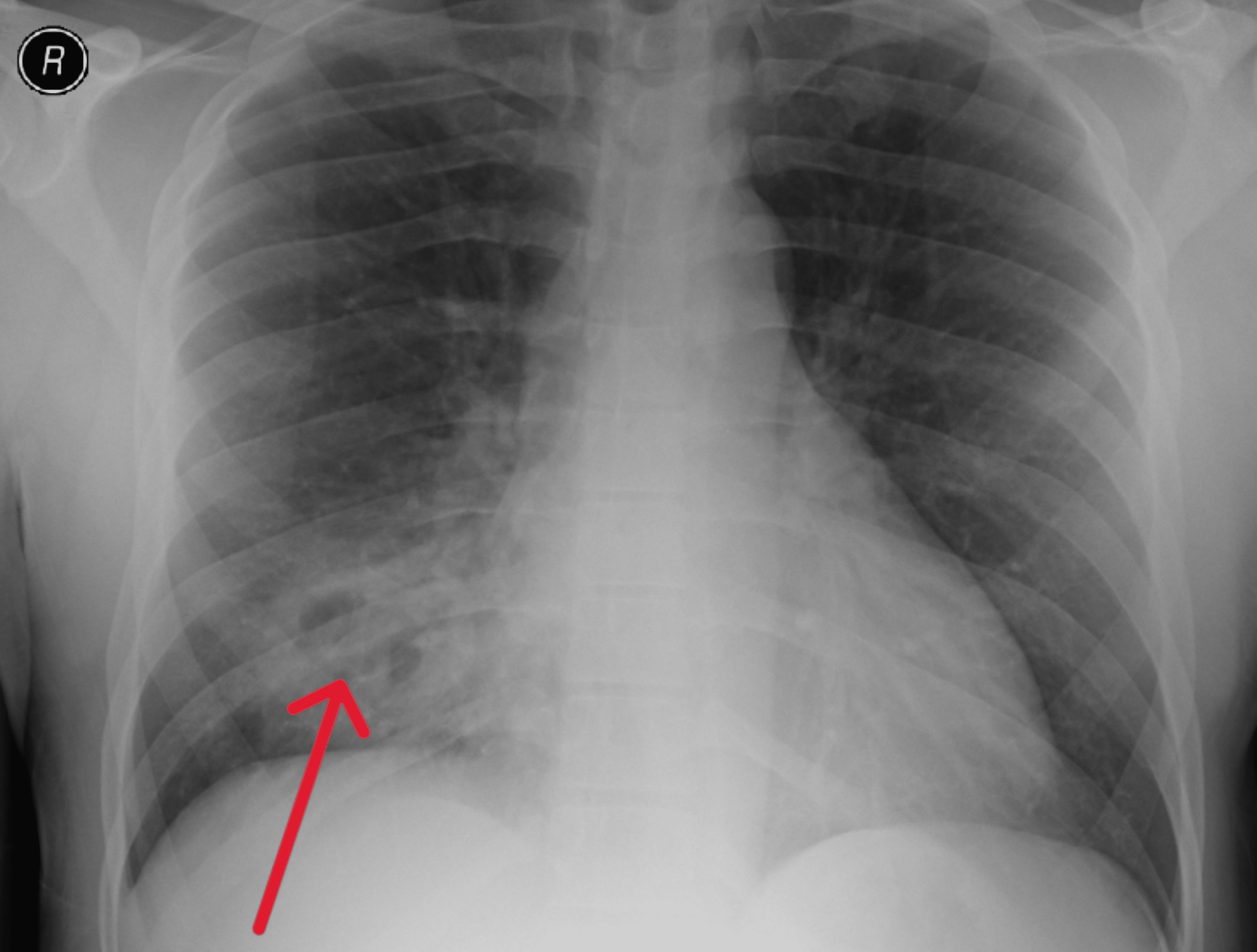 Diagnostic Dilemma in a Case of Necrotizing Pneumonia With Negative