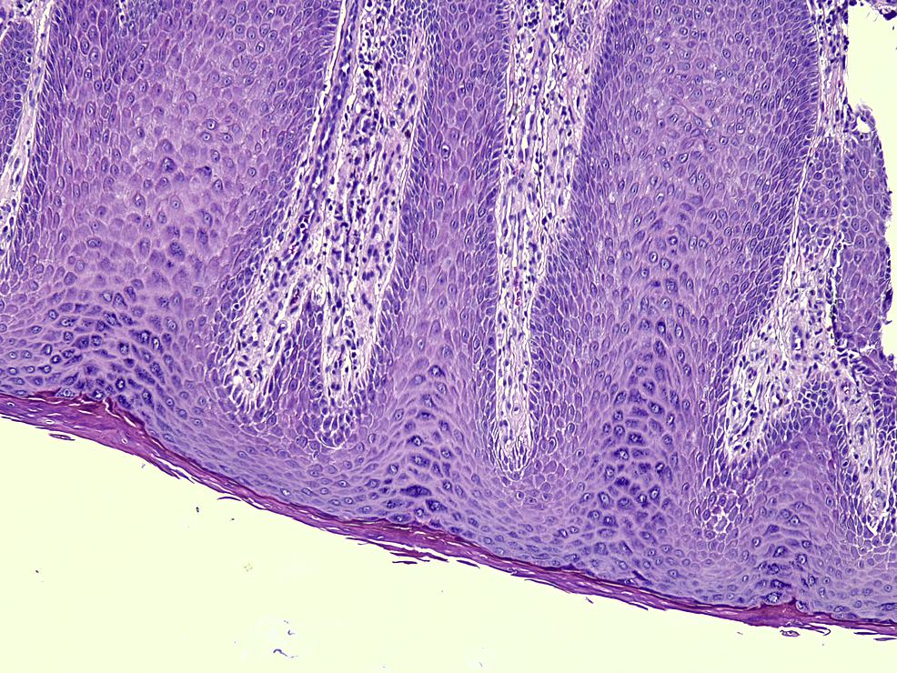 Cureus | Peristomal Pseudoverrucous Lesions: A Rare Skin Complication ...