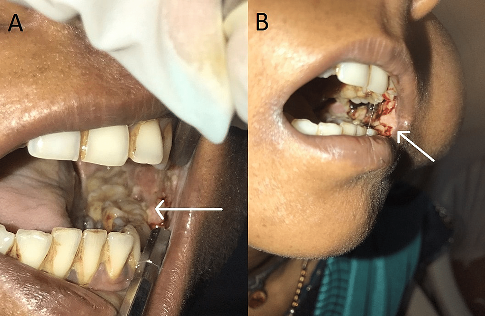 A 7-year retrospective study of biopsied oral lesions in 460