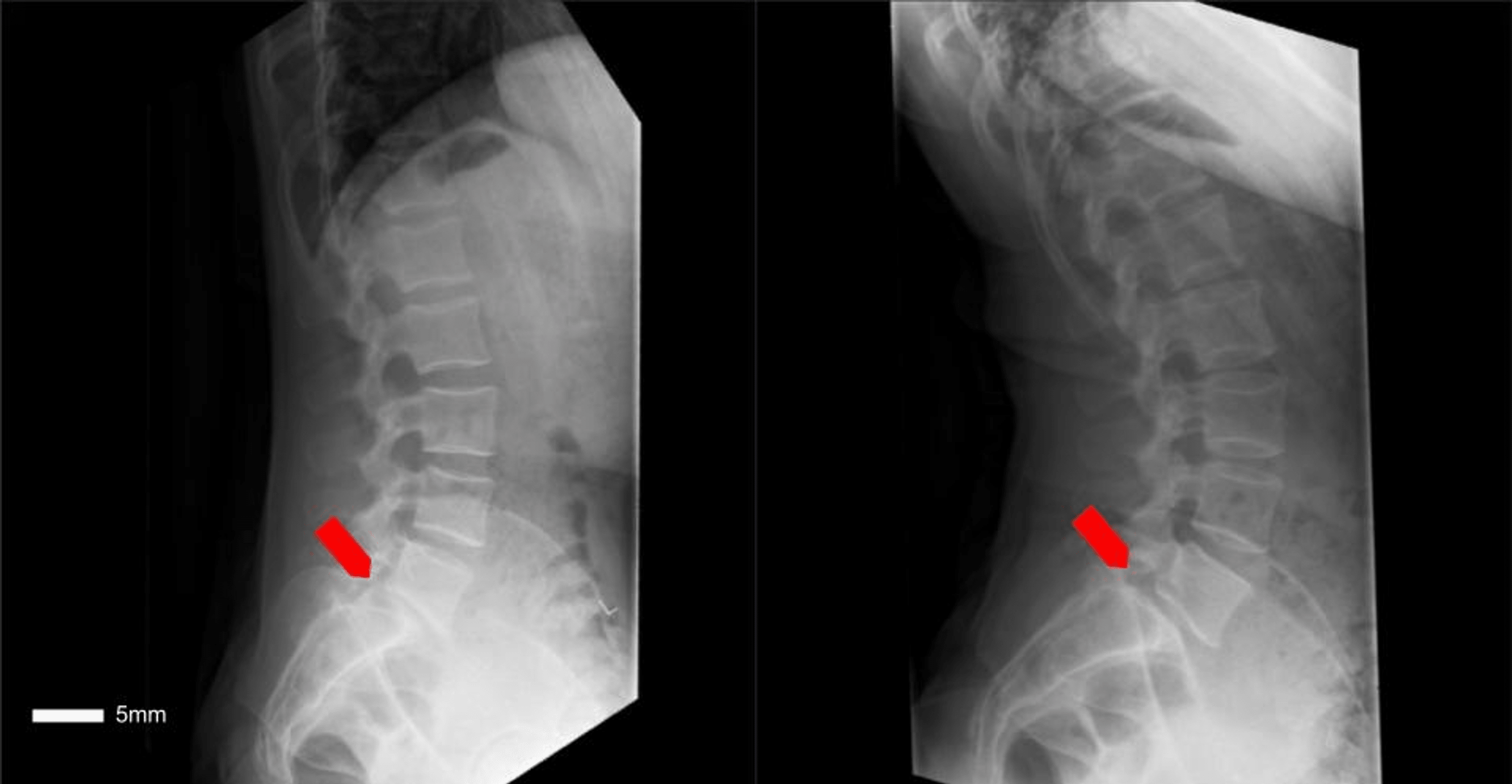 Abnormal L5S1 Facet Joint Orientation as a Harbinger of Degenerative Spondylolisthesis A Case