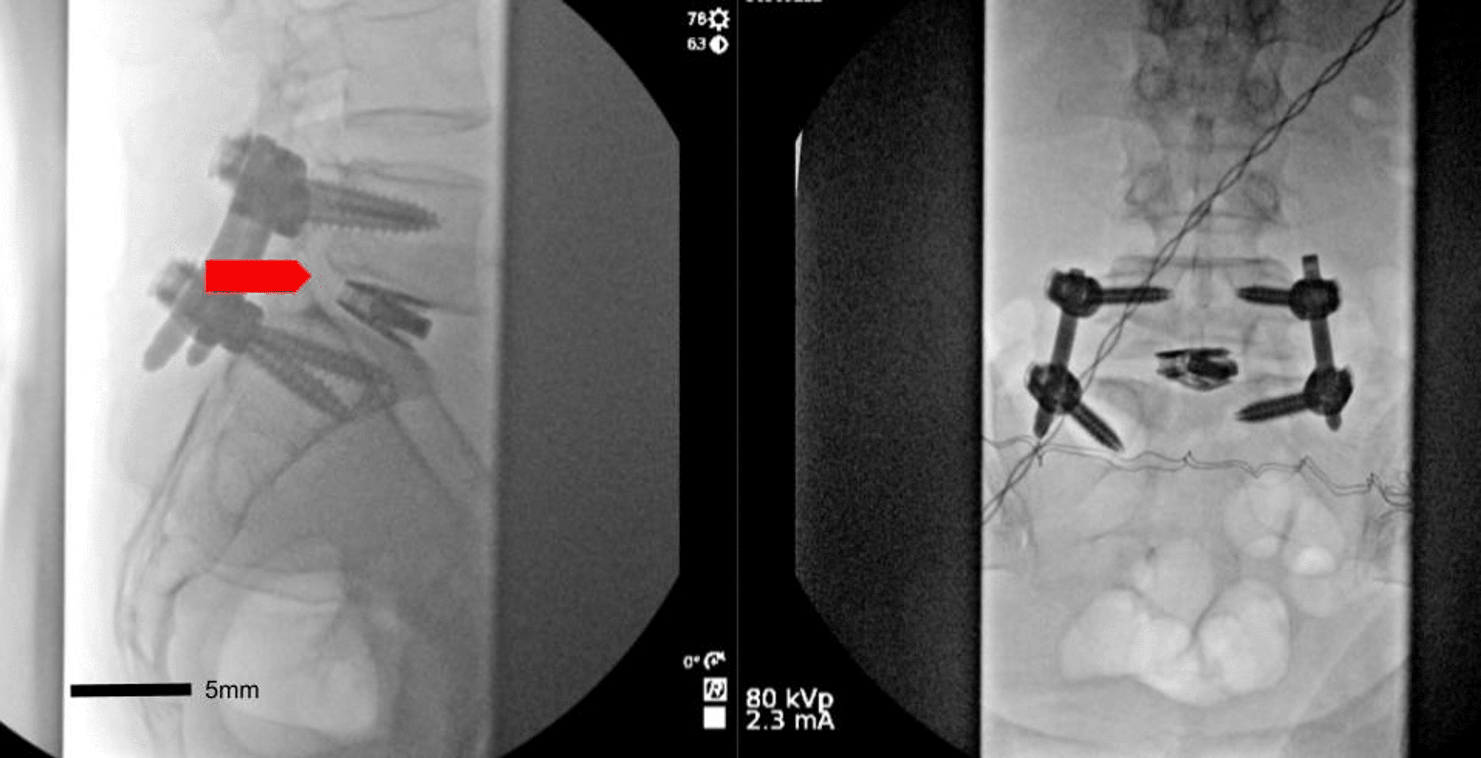 Abnormal L5S1 Facet Joint Orientation as a Harbinger of Degenerative