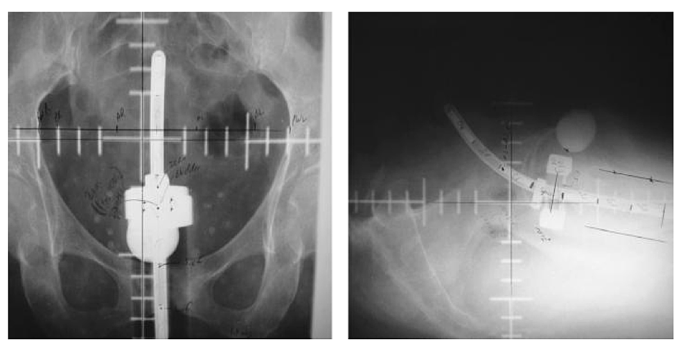 Cureus A Novel Applicator for Intracavitary LowDoseRate Brachytherapy (LDR) for Carcinoma of