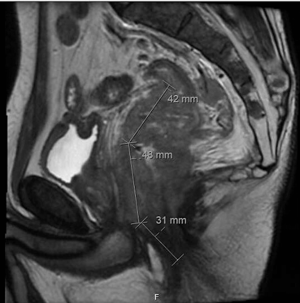 Cureus | A Rare Case of Primary Anorectal Hodgkin Lymphoma in an HIV ...