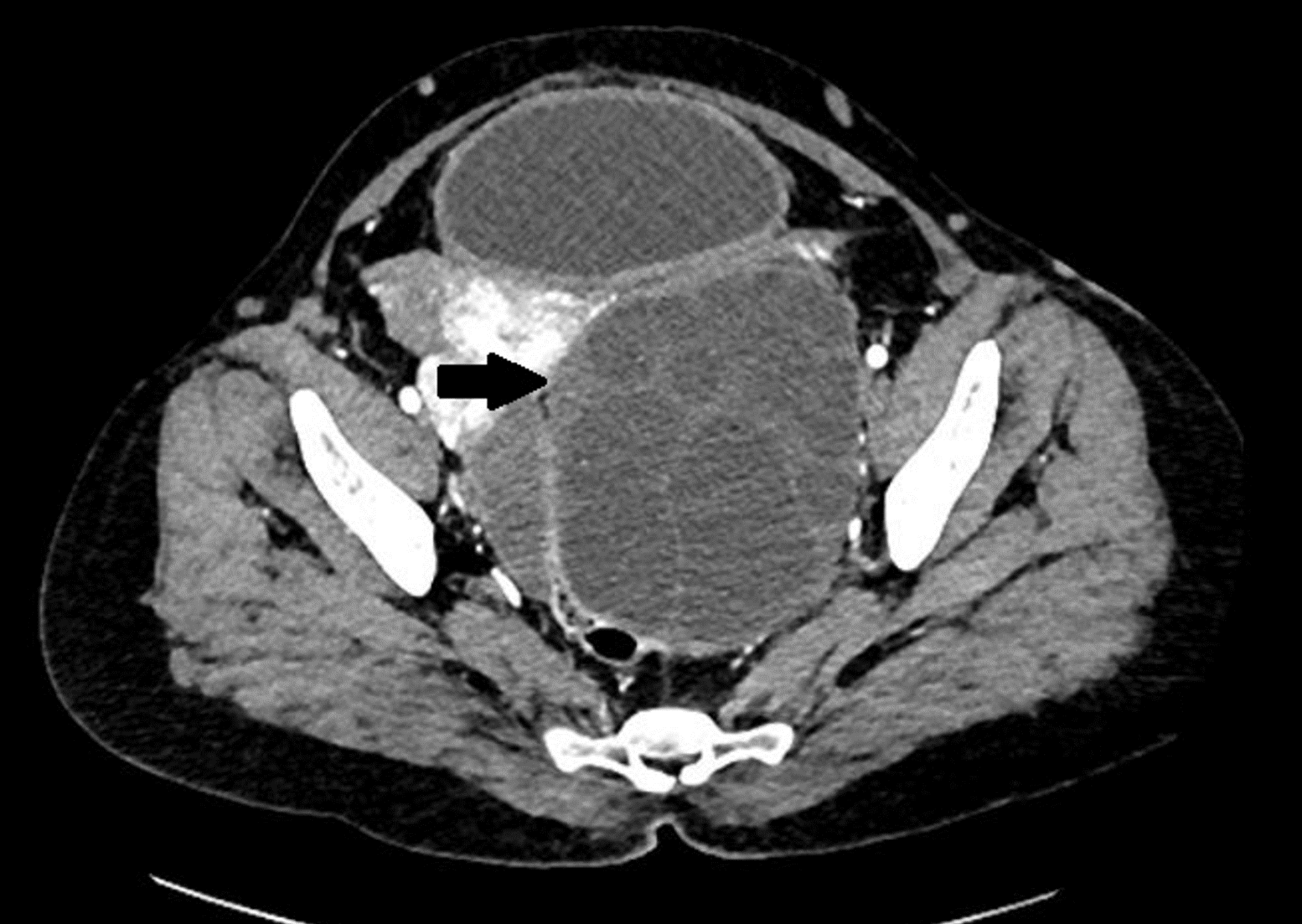 Cureus | Abdominal Hydatidosis: Unusual and Usual Locations in a North ...