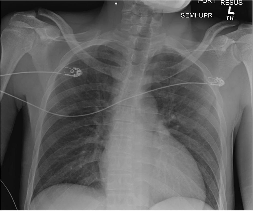 Streptococcus pneumoniae Serotype 23B Causing Asymptomatic Sinusitis ...