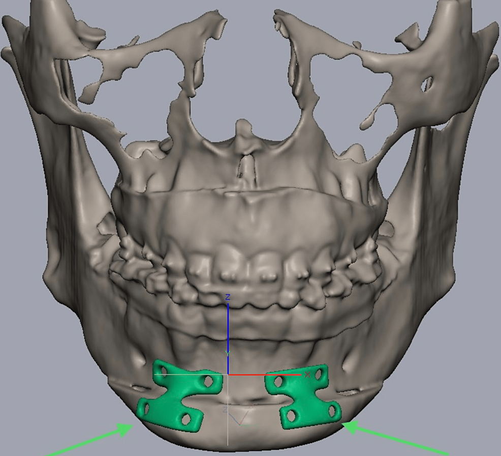 PatientSpecific Plates for Genioplasty A Case Report Cureus