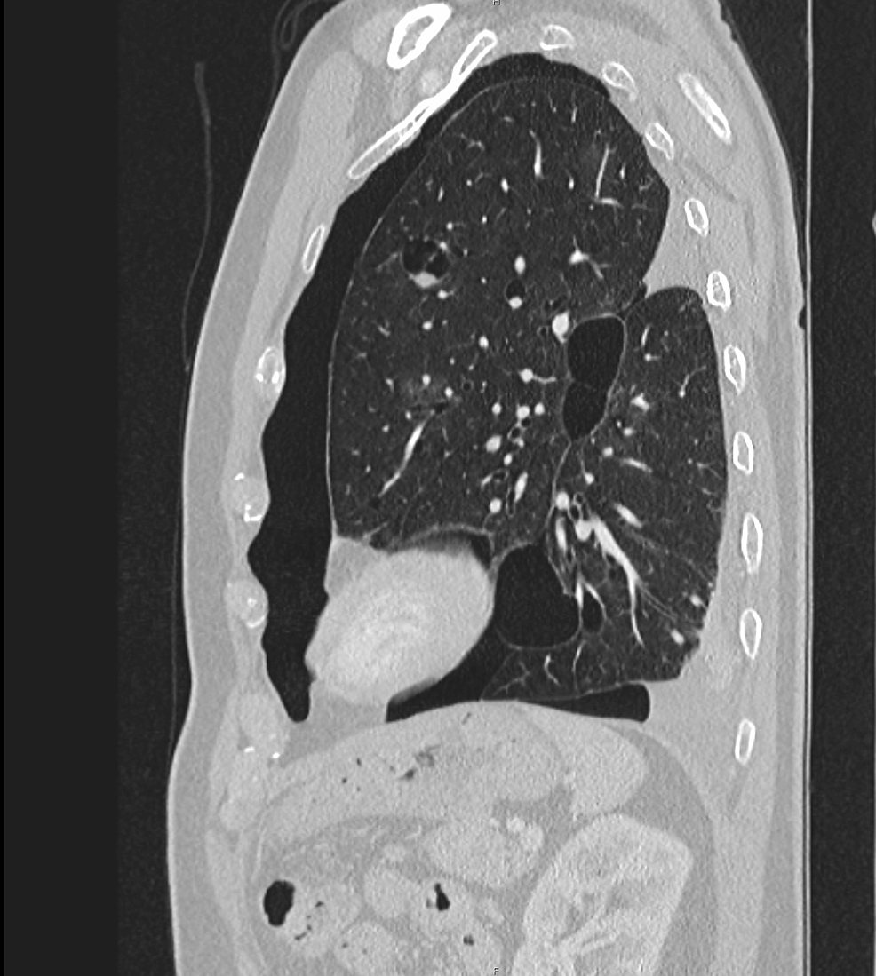 Cureus | Hydropneumothorax as a Presentation of Birt-Hogg-Dubé Syndrome