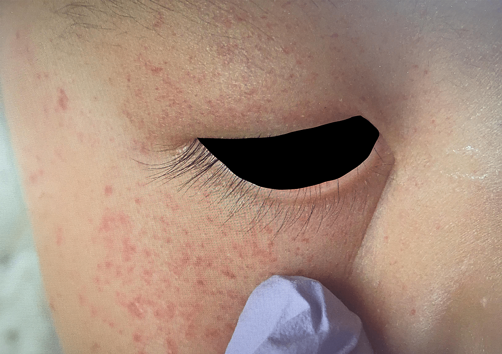 Neck HairThread Tourniquet Syndrome by Cosleeping With Family A Case