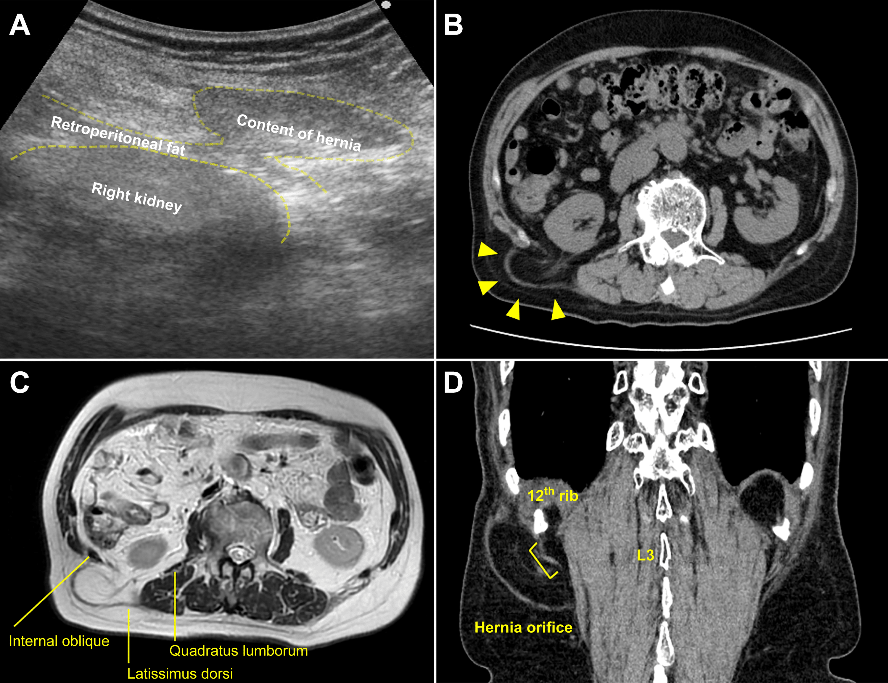 Cureus Identifying the Hernial Orifice in Superior Lumbar Hernia