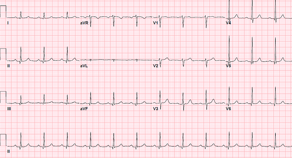 Unusual presentation of STEMI : Mobitz type 2 AV block