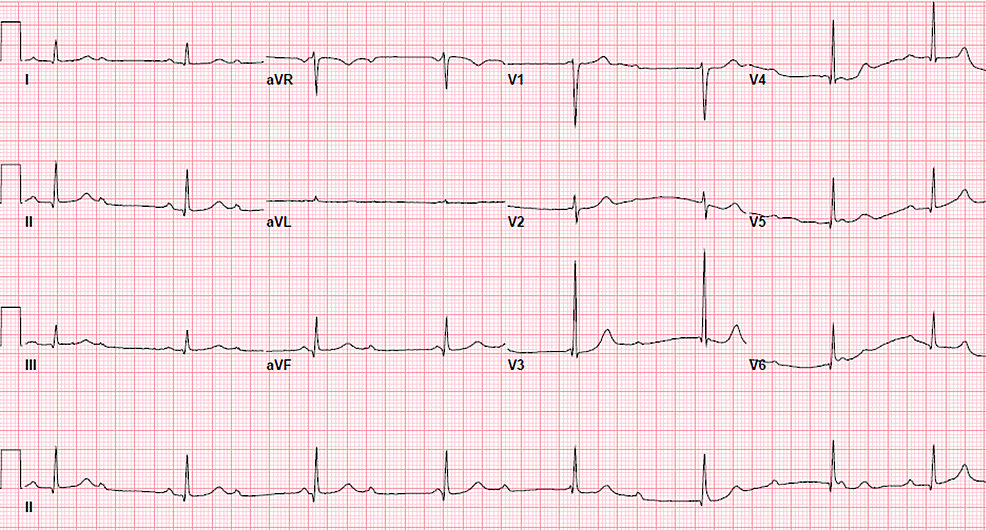 heart blocks heart blocks
