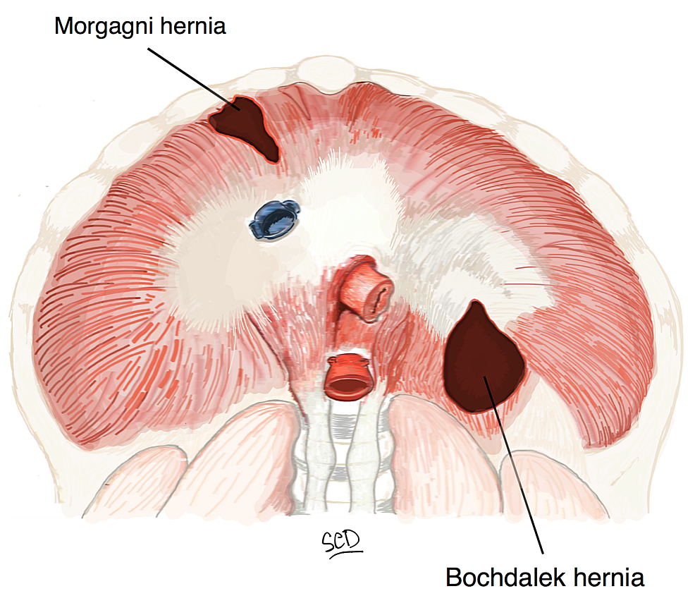 Surgical repair of diaphragmatic defect using a Gore-tex mesh. (A) A