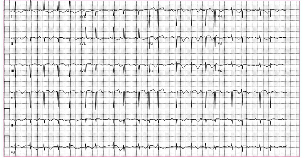 Cureus | Stress Cardiomyopathy in Association with Severe Agitation in ...