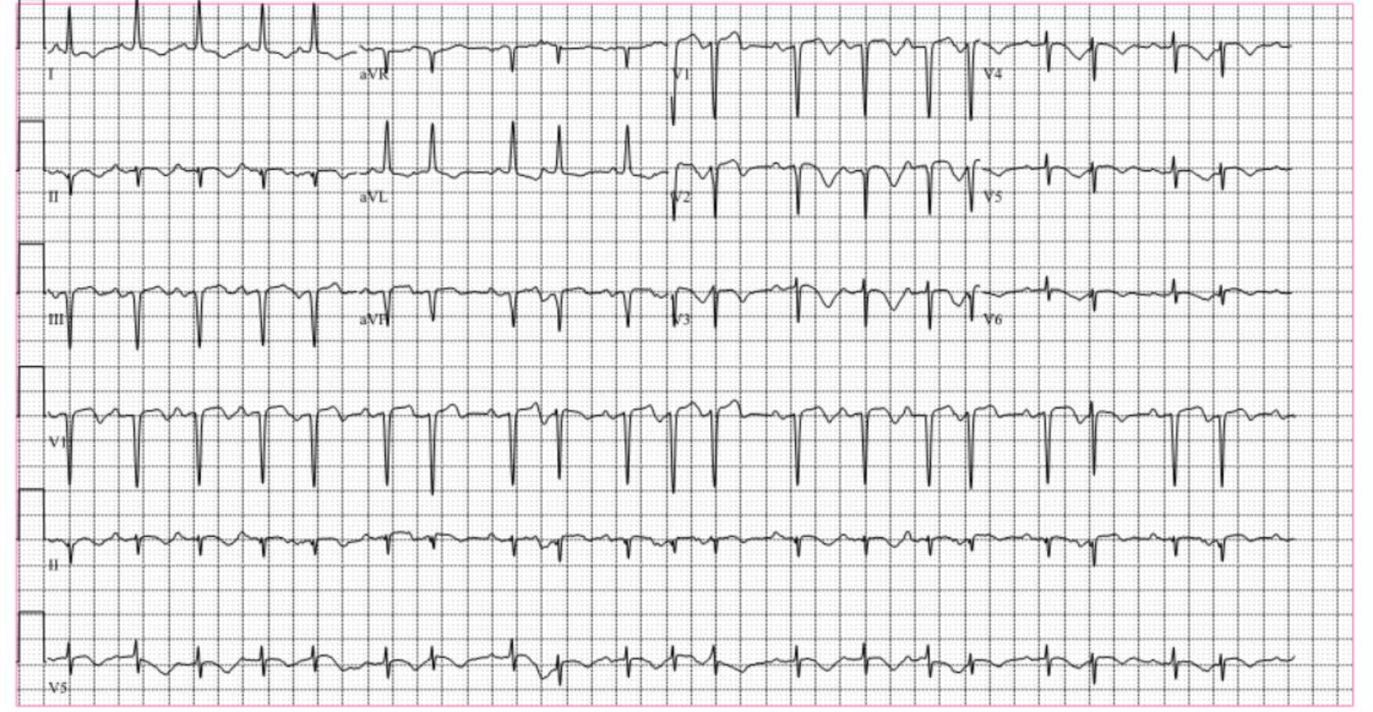 12 Lead ECG Sinus Tachycardia